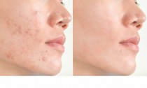 Acne scars and pores. Black spots, wrinkles and skin problems  Facial Treatment Step