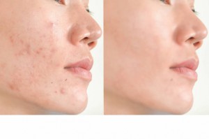 Acne scars and pores. Black spots, wrinkles and skin problems  Facial Treatment Step