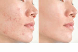 Acne scars and pores. Black spots, wrinkles and skin problems Facial Treatment Step