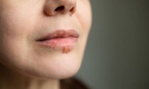 A stock photo of a woman with herpes viral cold sore on her lip and mouth. Antiviral cream can relieve burning, itching, or tingling. Herpes labialis, commonly known as cold sores, is a type of infection by the herpes simplex virus that affects primarily the lip. This is the most common form of infection usually called cold sores or fever blisters.