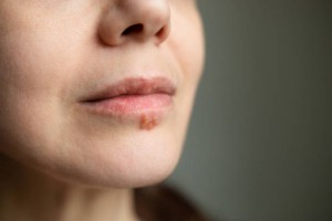 A stock photo of a woman with herpes viral cold sore on her lip and mouth. Antiviral cream can relieve burning, itching, or tingling. Herpes labialis, commonly known as cold sores, is a type of infection by the herpes simplex virus that affects primarily the lip. This is the most common form of infection usually called cold sores or fever blisters.