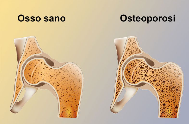 osteoporosi 1