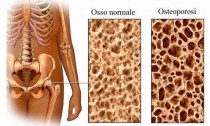 osteoporosi 2