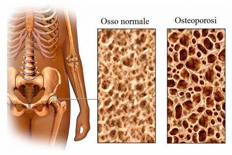 osteoporosi 2