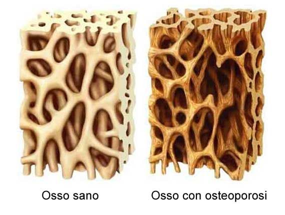osteoporosi 3