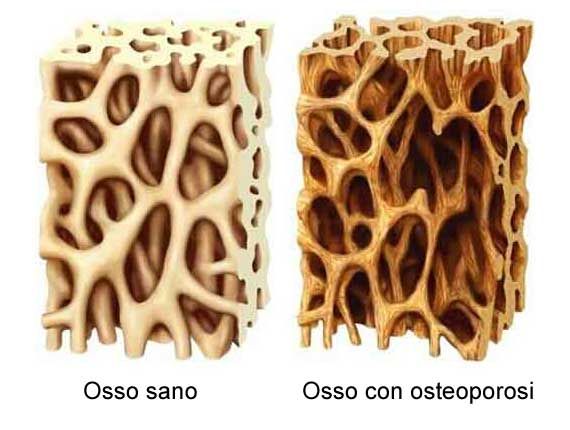 osteoporosi 3
